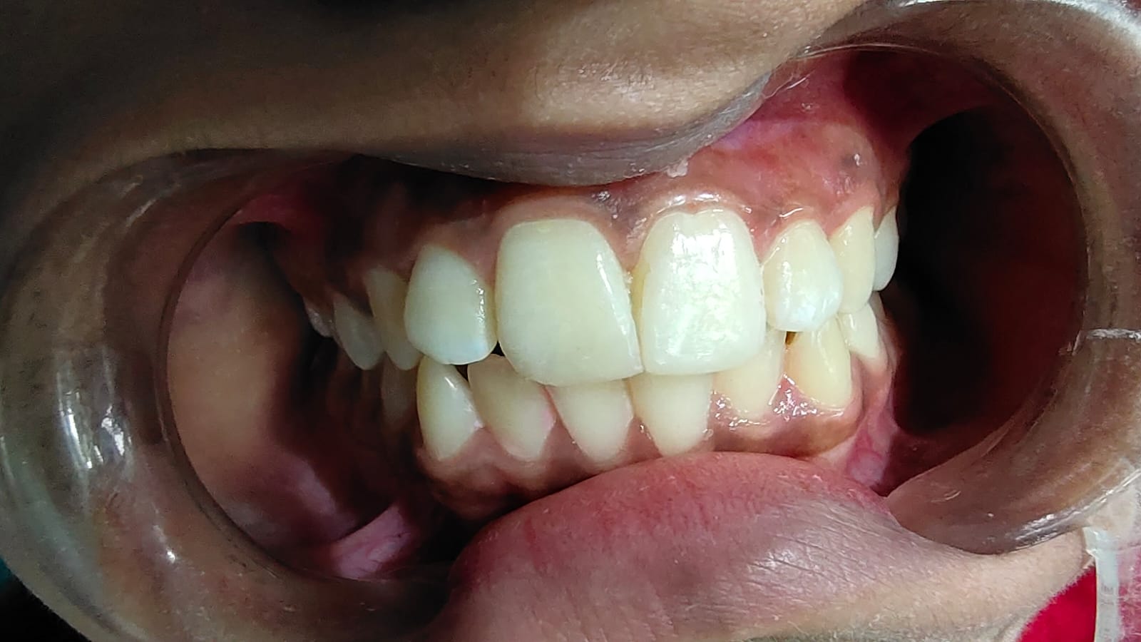 After treatment
