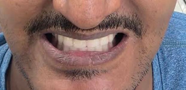 After treatment