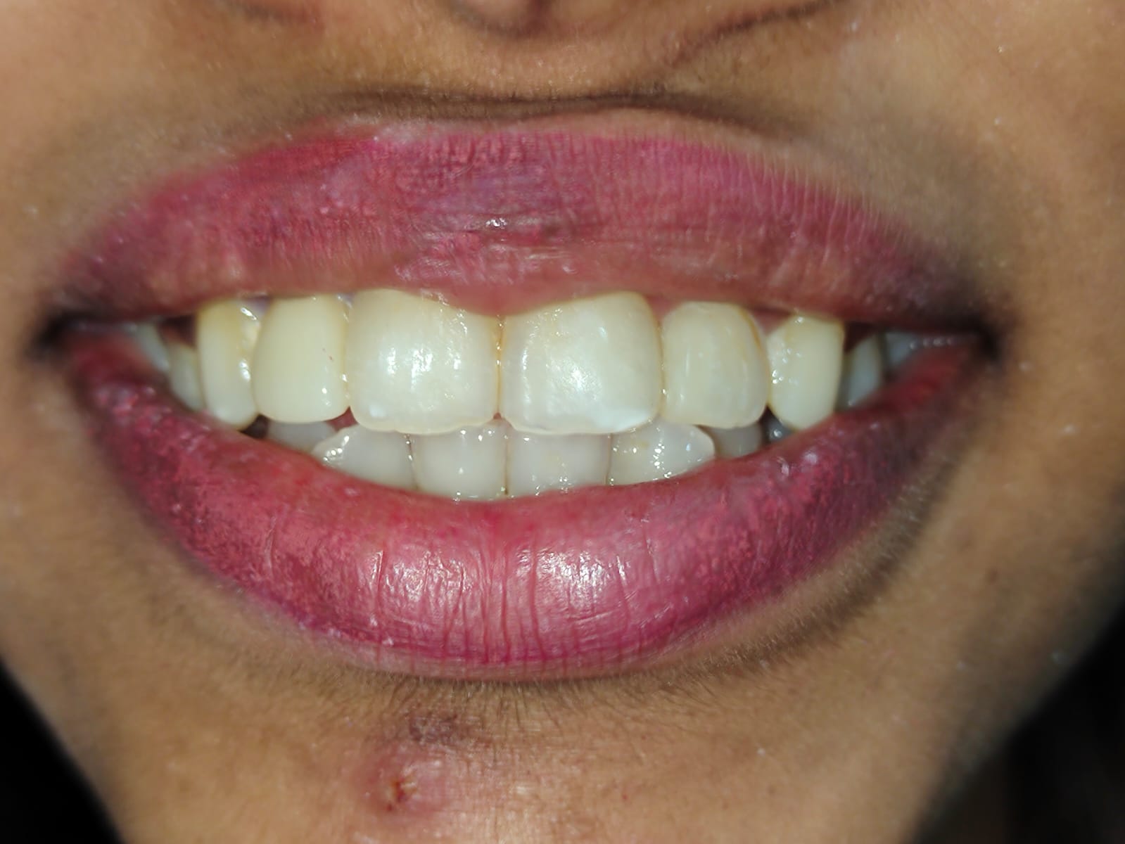 After treatment