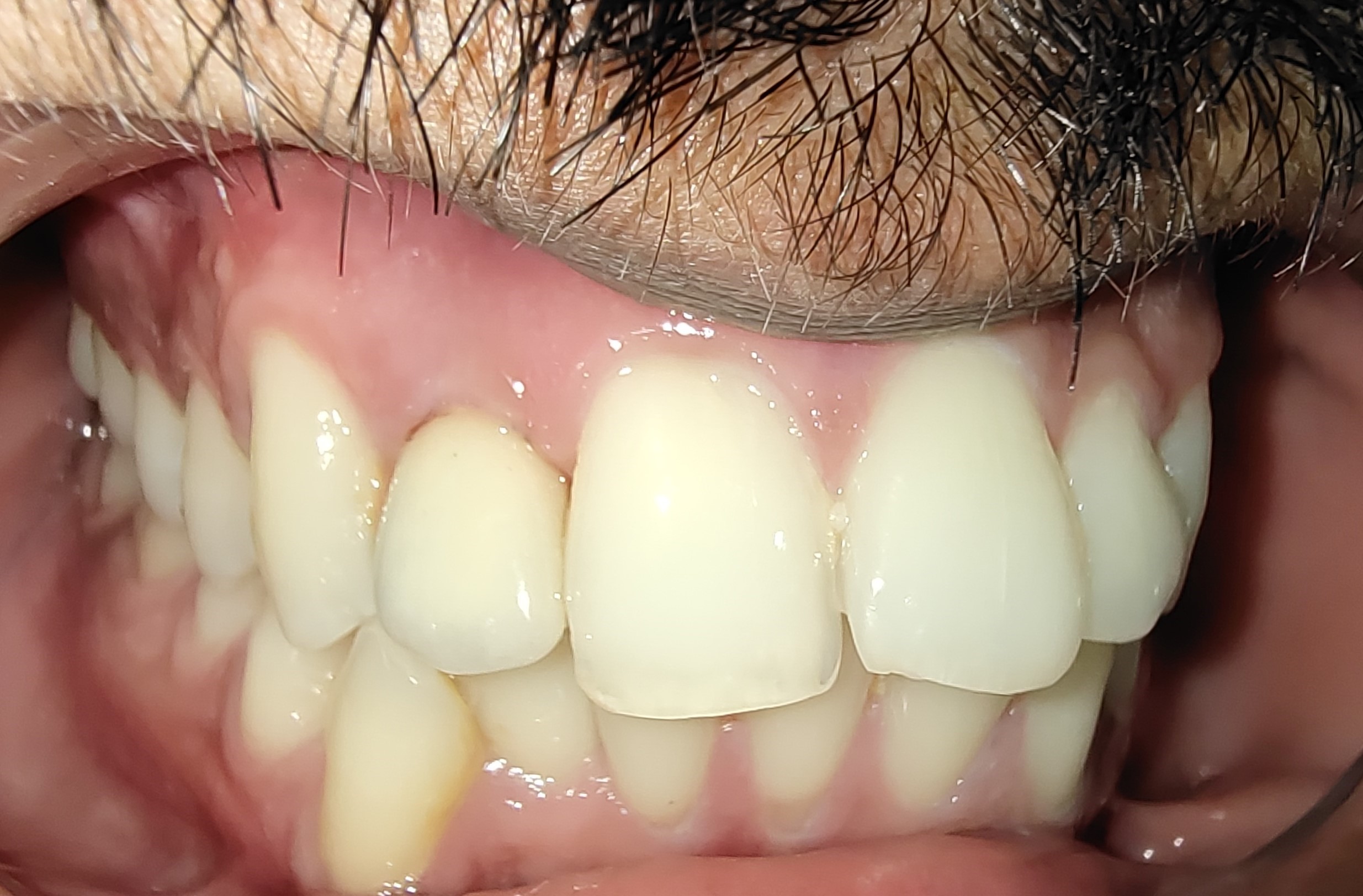 After treatment