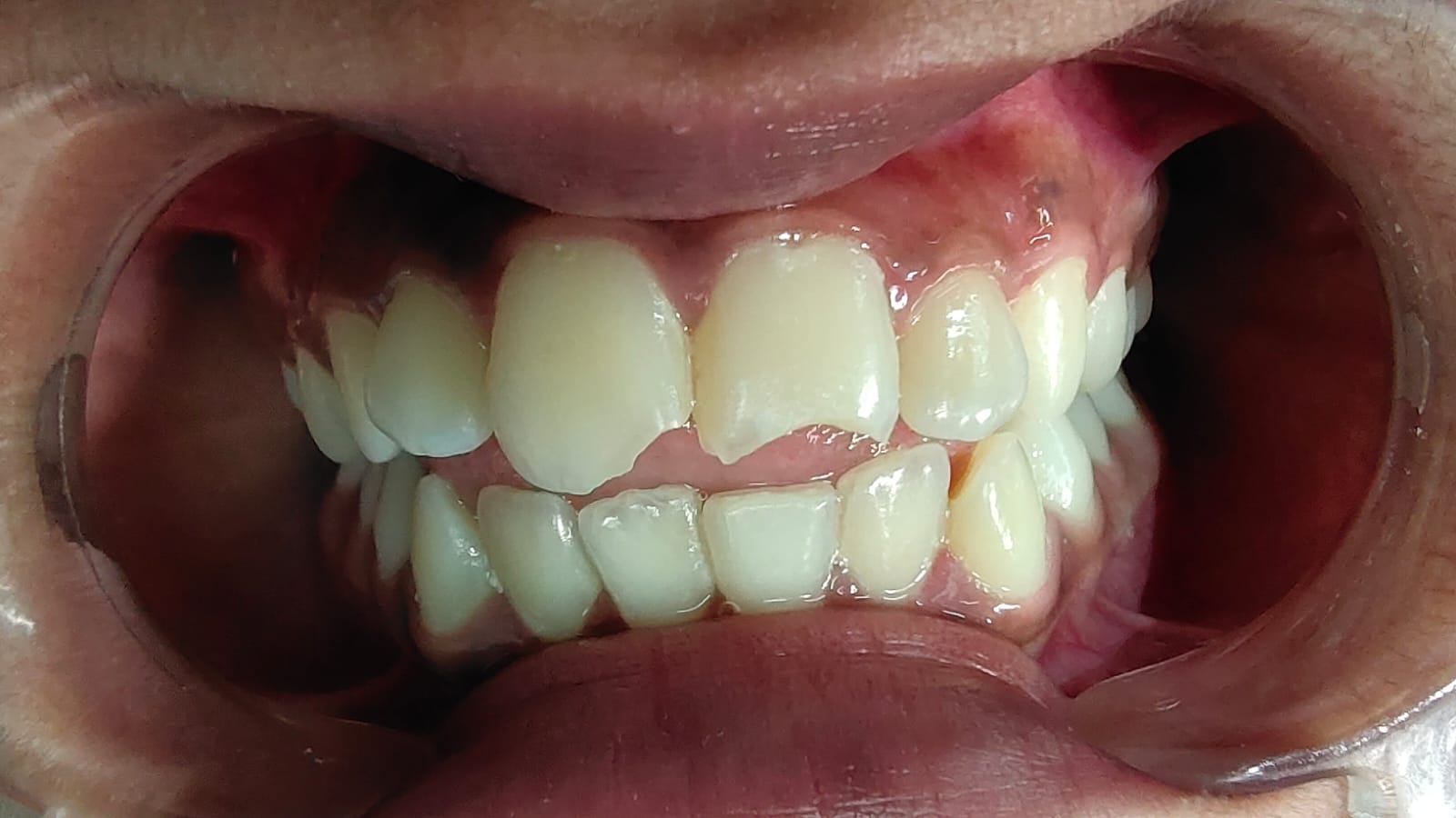 Before treatment