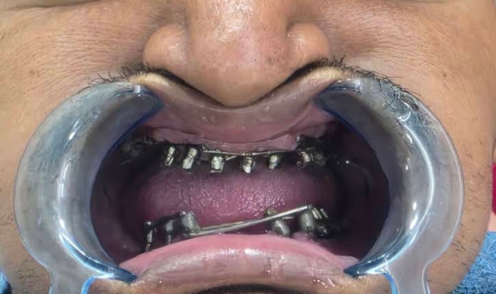 Before treatment
