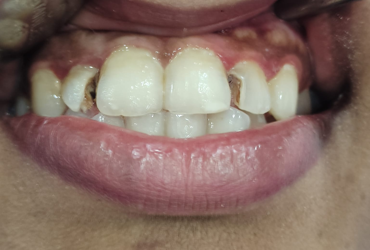 Before treatment