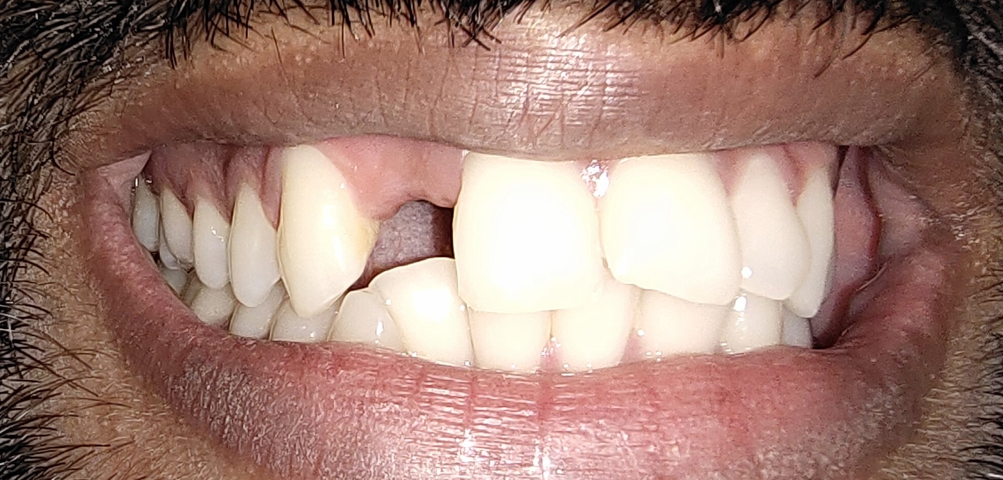Before treatment